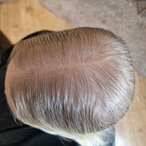 Treatments For Hair Loss In Women Near Me