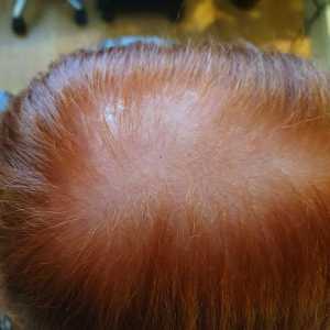 non-surgical hair loss treatments for women in Berkshire at Perfectly Posh