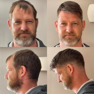 Non Surgical Men's Hair Replacement System Hungerford